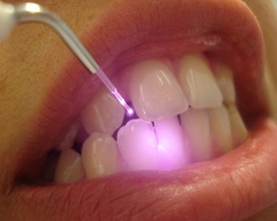 Как лечить пародонтит зубов и десен 